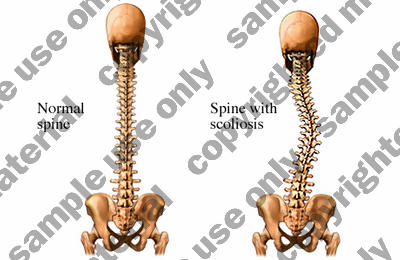 spine_scoliosis.jpg